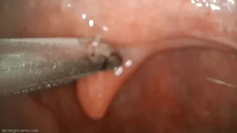 Uvula Manipulation With Swab And Forceps (720 Mp4)